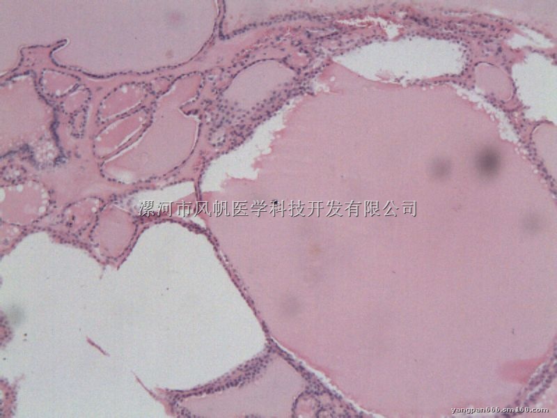 【最新】肺腺癌病理切片图片||肠腺癌病理切片高倍镜